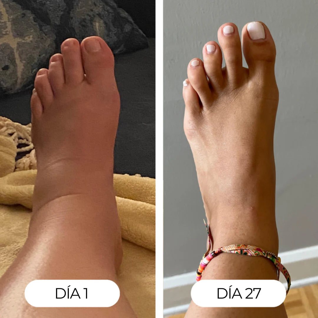 Pie y tobillo hinchados el día 1 y deshinchados el día 27
